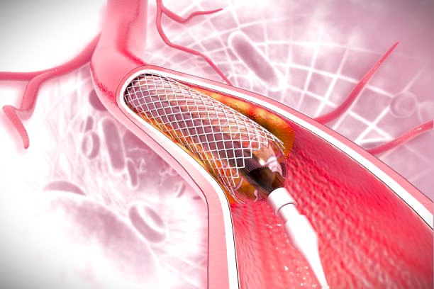 best cardiologist for angioplasty in south mumbai